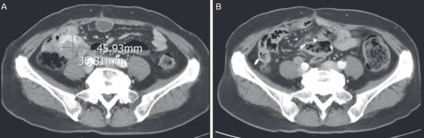 Fig. 2. Pelvic computed tomography images showing (A) a size increase in 2 peritoneal seeding nodules after 3 cycles of intravenous  gemcitabine, in November 2012; (B) absence of new lesions after 6 cycles of intraperitoneal chemotherapy, in March 2013.