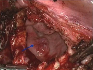Fig. 2. Pathologic findings. (A) Dermis with hypercellular epithelioid melanocytes and variable sized vessels (hematoxylin and eosin [H&amp;E] 