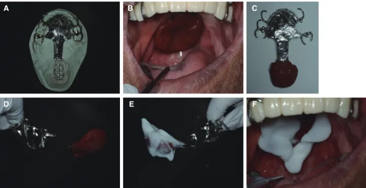 Fig. 7. Bordermolding and Pharyngeal obturator final impression. (A) Metal framework, (B, C, D) Functional impression for  pharyngeal part, (E, F) Bordermolding.