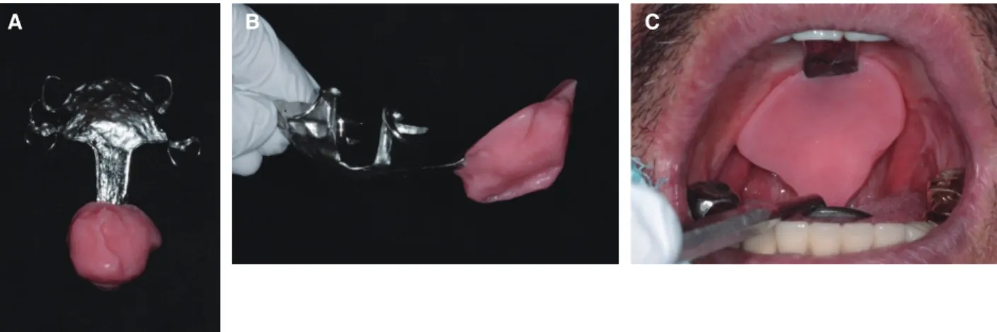 Fig. 10. Definitive restoration. (A) Right lateral view, (B) Frontal view, (C) Left lateral view