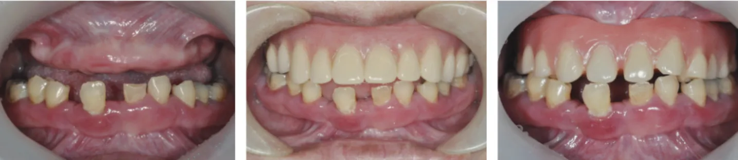 Fig. 5. CT stent made by duplication of complete denture. Fig. 6. Panoramic radiograph after implant surgery.