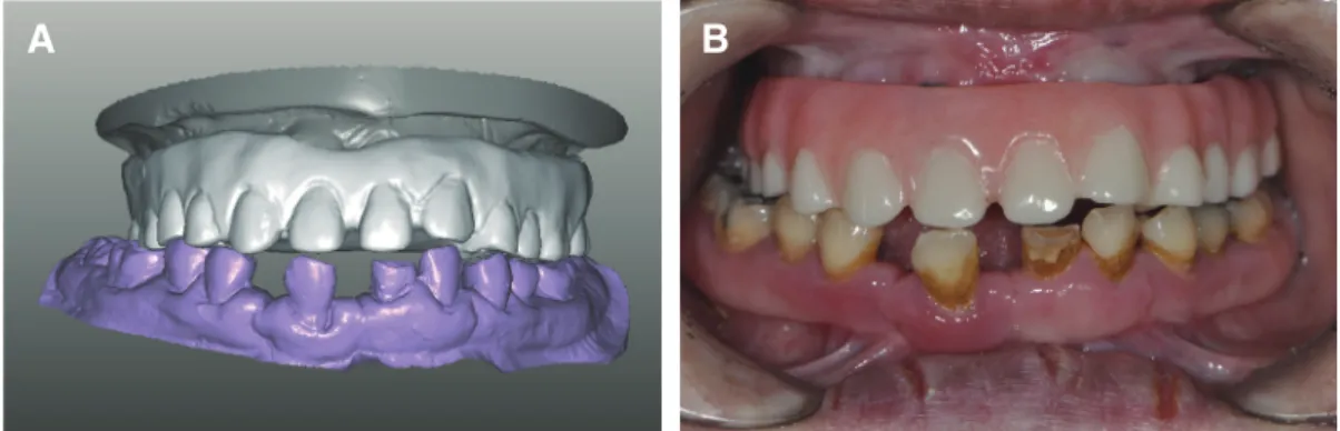 Fig. 8. Temporary crown was fabricated with scan data of old denture. (A) Old denture model scan image, (B) Temporary crown.