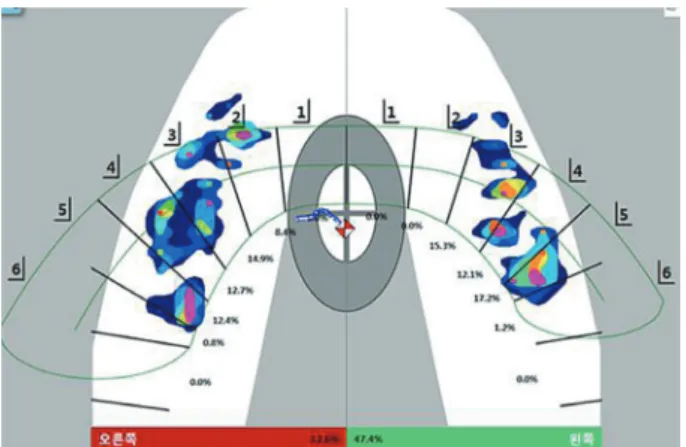 Fig. 14. Occlusal analysis using T-scan III: Equal distribu- distribu-tion of occlusal force for whole dentidistribu-tion.