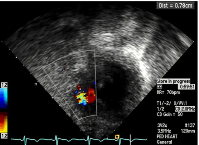 Fig. 3. Postoperative echocardiogram. Showing no remnant ven- ven-tricular septal defect.