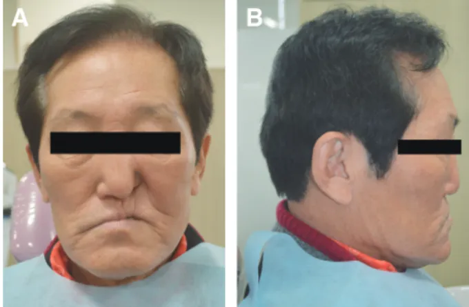 Fig. 1. Intraoral view. Fully edentulous ridge with partial 