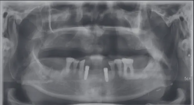 Fig. 4. Temporary obturator (A, B). Artificial teeth were exposed due to the scar contracture and the temporary  obturator’s excessive lip support (C)