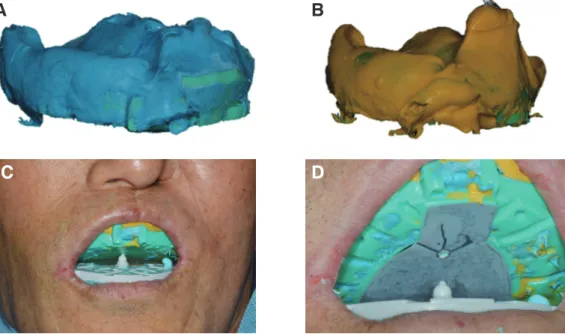 Fig. 5. Final impression of CAD-CAM obturator by the Magic denture system. 1st impression with heavy body PVS  material (A)