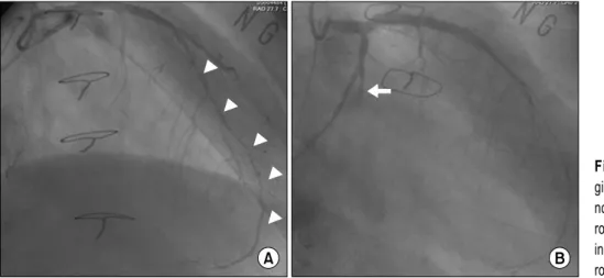 Fig. 1. Preoperative coronary an- an-giography shows (A) diffuse  ste-nosis up to 50% in mid-LAD  (ar-row head) and (B) total occlusion  in OM branch of LCx (white  ar-row)