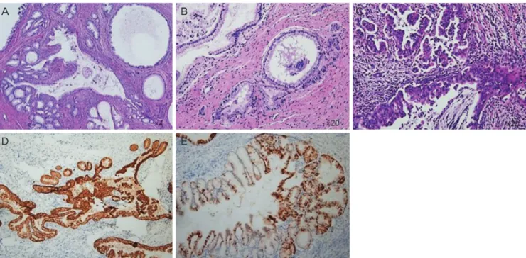 Fig. 2. Histopathological results of colposcopic biopsy (A, B) and cervical conization (C-E)
