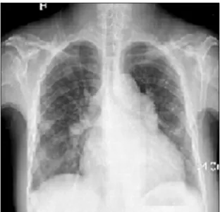 Fig. 1. Chest X-ray shows multifocal patchy opacity in both lungs  and enlarged heart size.