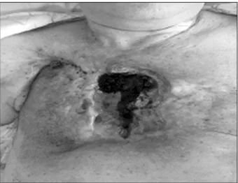 Fig. 3. (A∼C) Chest computed to- to-mography scan images: Patency of  arch branch vessels are well  main-tained without endoleak formation  or stent migration