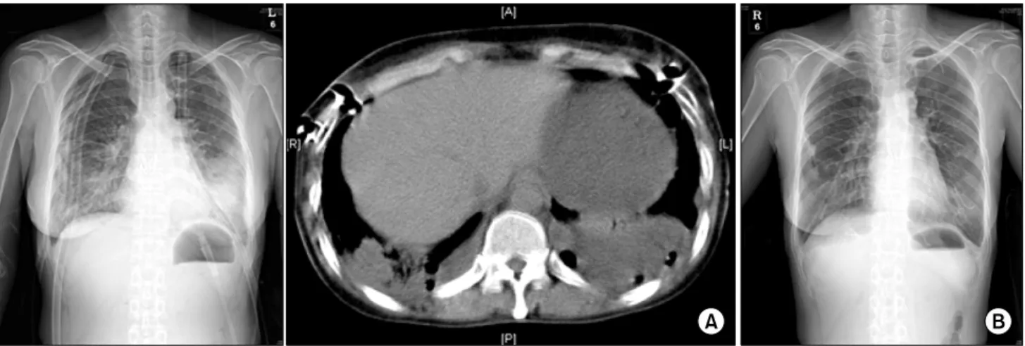 Fig. 2. Chest X-ray and chest computerized tomography (CT) of case 2 patient. (A) Chest X-ray and chest CT before decortication