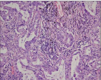Fig. 2.  Adenocarcinoma of case I (H&amp;E stain, ×200).