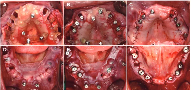 Fig. 6. Implant fixture placement. (A) Adaptation of maxillary surgical guide, (B) Maxilla after implant fixture placement,  (C) Maxilla after surgery, (D) Adaptation of mandibular surgical guide, (E) Mandible after implant fixture placement, (F)  Mandible