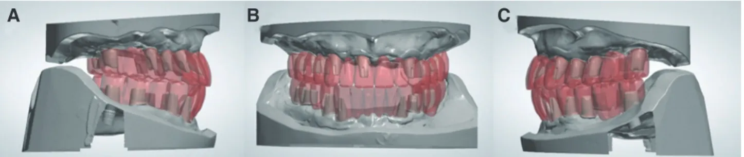 Fig. 10. Design of customized titanium abutment, digital wax up for provisional prosthesis