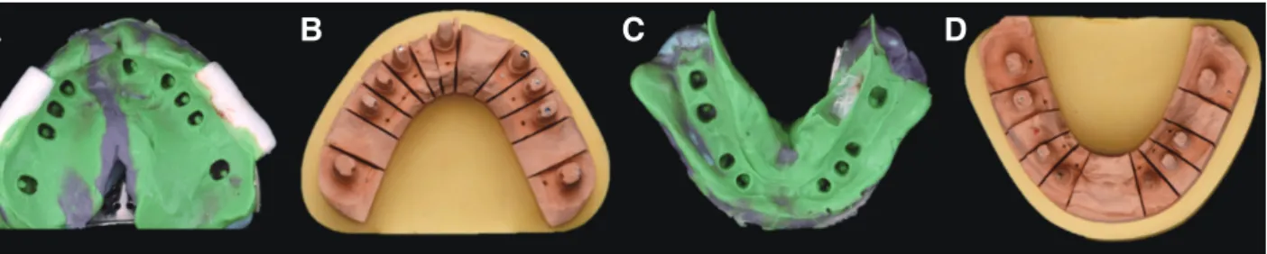 Fig. 13. Final impression and master cast fabrication for definitive prosthesis. (A) Final impression of maxilla, (B) Master  cast of maxilla, (C)Final impression of mandible, (D) Master cast of mandible.