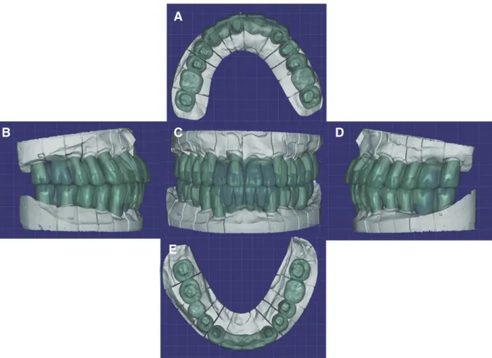 Fig. 16. Digital wax up of definitive prosthesis. (A) Maxillary occlusal view, (B) Right lateral view, (C) Frontal view, (D)  Left lateral view, (E) Mandibular occlusal view.