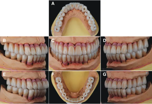 Fig. 17. Definitive prosthesis on master cast. (A) Maxillary occlusal view, (B) Right lateral view, (C) Frontal view, (D) Left  lateral view, (E) Lateral movement - right side: group function, (F) Mandibular occlusal view, (G) Lateral movement - left  side