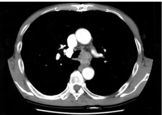 Fig 2. Fiberbronchoscopic finding showing  firm  mass  ex- ex-tending from the lower trachea into the left mainstem bronchus.