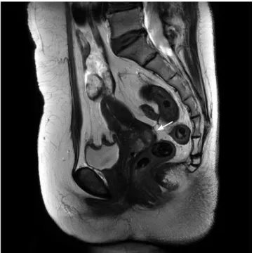 Fig. 1. Pelvis magnetic resonance imaging (MRI) revealed a 3.9  cm sized cervical mass without parametrial and vaginal extension.