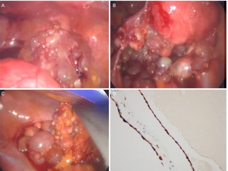 Fig. 2. (A) On laparoscopy, multiple grapelike clusters of cysts appear to originate from the peritoneum