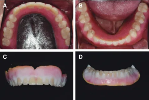 Fig. 8. Wax denture (A, B), External impression on upper wax- denture using Coe-soft (C) and External impression on  lower wax- denture using Coe-soft (D).