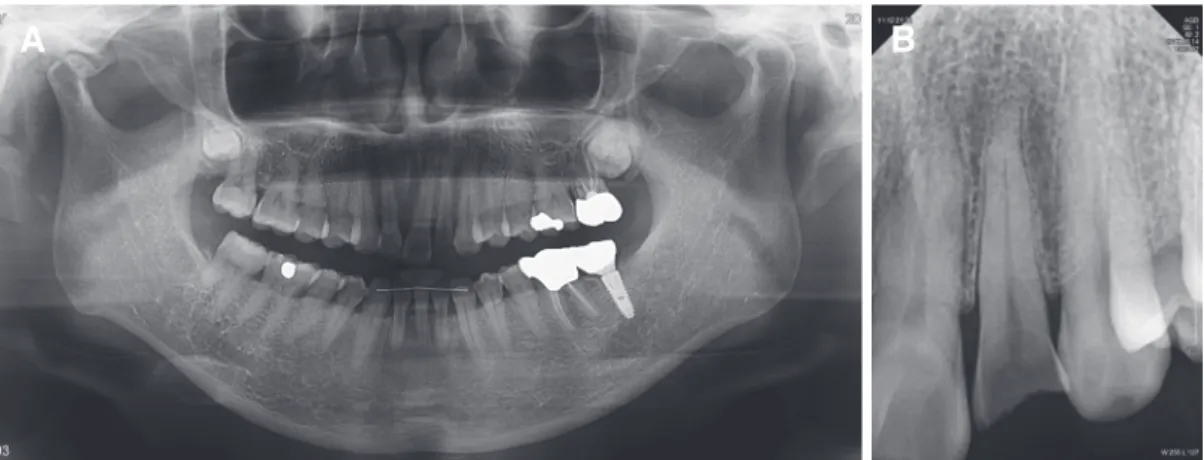 Fig. 1. Initial radiographic image. (A) Panoramic view, (B) Periapical view. Crown fracture with pulpal exposure is shown.