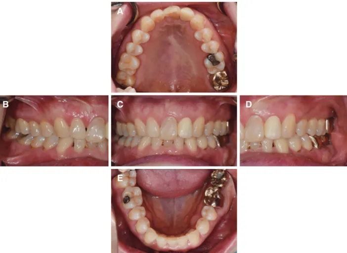 Table 2. Measurement of the width and length of the modified teeth on the diagnostic wax-up cast