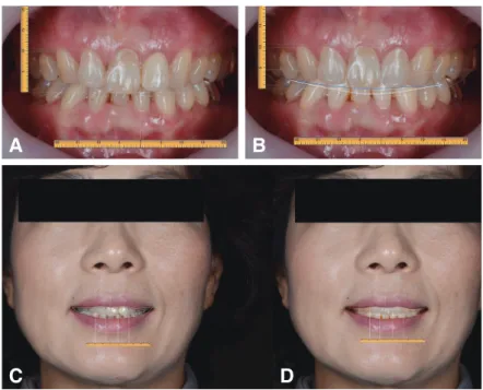 Fig. 3. Facial view of pretreatment  aspect. Midline discrepancy and  discoloration of maxillary central  incisor are shown.