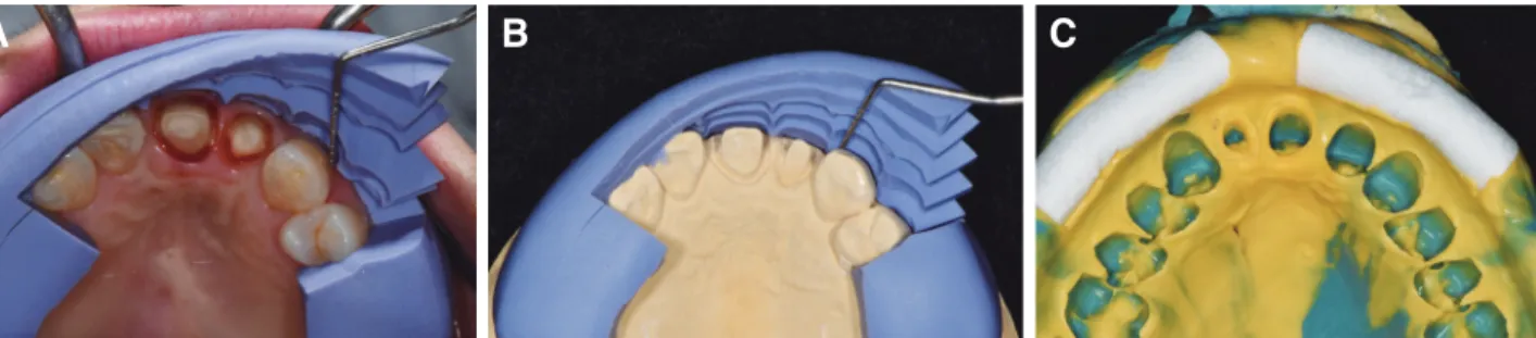 Fig. 8. Tooth preparation and impression taking. (A) and (B) The putty index was used to guide and check the amount of  reduction, (C) Final impression taking with VPS.