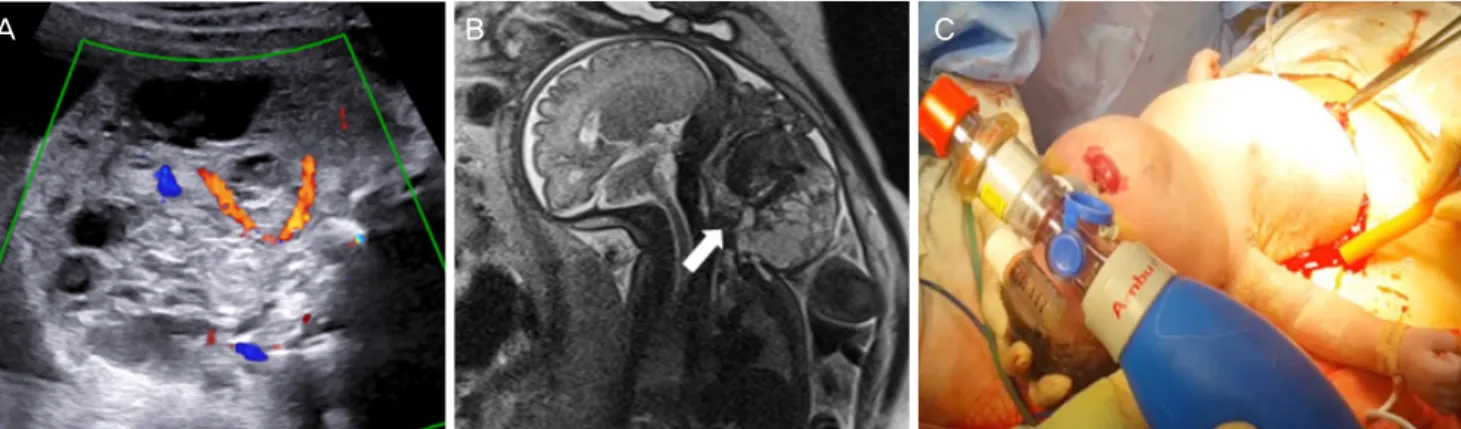 Fig. 1. Ultrasonographic findings at 30.3 weeks of gestation showing a huge heterogeneous solid mass on the fetal neck with high vas- vas-cularity (A)