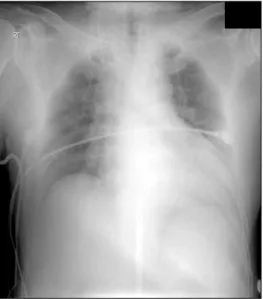 Fig. 1. Chest AP. 어 급성 신부전증 의심 하에 신장내과적인 검사가 진행되 었다.  응급실 내원 5시간 뒤에 시행한 혈액 검사에서 헤모 글로빈이  13.5  g/dL에서  8.5  g/dL로  저하되었고  호흡곤란  증상의 악화 및 전신 순환장애에 의한 피부 점상 출혈이  나타나기  시작했다