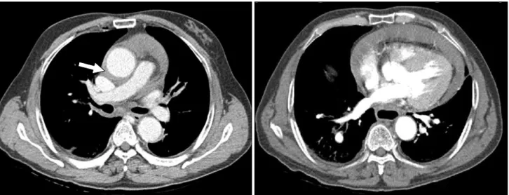 Fig. 4. Postoperative aorta CT.