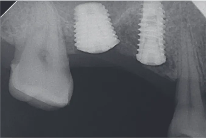 Fig. 11. Periapical view after surgery.