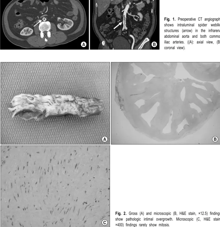 Fig. 1. Preoperative CT angiography  shows intraluminal spider weblike  structures (arrow) in the infrarenal  abdominal aorta and both common  iliac arteries