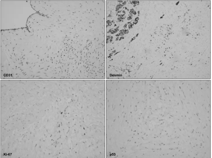 Fig. 3. Immunohistochemistry of the specimen shows that CD31 is positive in endothelial lining, desmin positive in some part, Ki-67 pos- pos-itive in 1% and p53 negative.