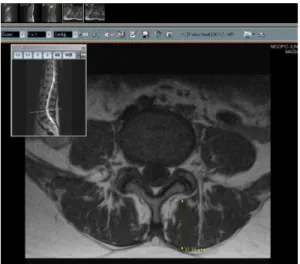 Fig 1. 요추4-5번 종축(axial)자기공명영상에서 추간판 (Disc),  요근(PS),  척추기립근(ES),  다열근(MF) 의  횡단면적(CSA)측정시  사용하는  관심영역 (ROI) Fig  2