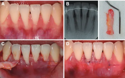 Fig. 4. Clinical view of case 2 at maintenance check. (A) Stitch-out, (B) 1 months, (C) 3 months after surgery.