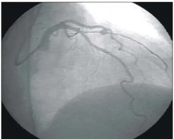 Fig. 2. Coronary angiography after percutaneous transluminal  coronary angioplasty shows the entire length of the first  diagonal branch which is long and atherosclerotic.
