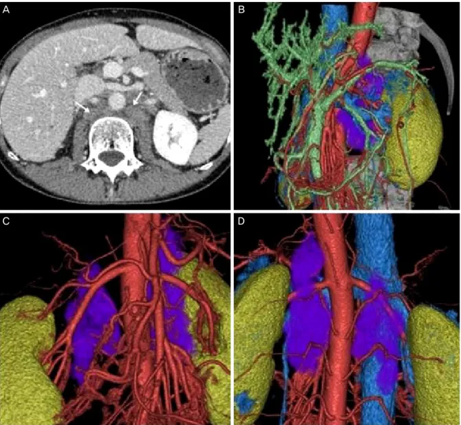 Fig. 1. (A) Computed tomography (CT) image; arrows indicate the retro-crural metastatic lesions