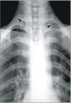 Fig. 3. Chest CT scan reveals interstitial free air collection  along subsegmental segmental arteries and veins of right  middle lobe (arrows).