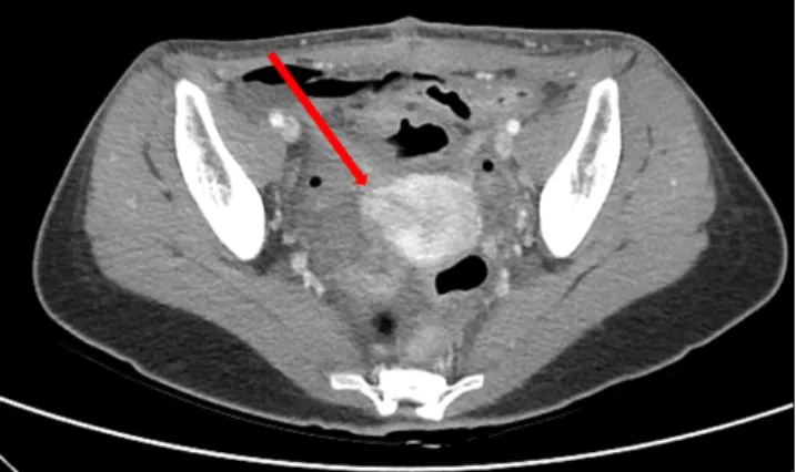 Fig. 2. Postoperative abdominal-pelvic computed tomography; im- im-mediate postoperative state without evidence of dehiscence