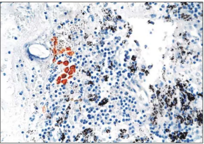 Table 1. Clinical features of 41 patients with stage I non-  small cell lung cancer