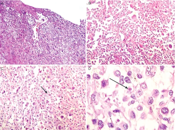 Fig. 1. Hematoxylin and eosin stained sections show (A) a tumor in the subepithelium with junctional activity and surface ulceration