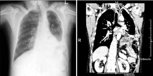 Fig. 2. Pre operative upper gastro- gastro-intestinal study (left) and  gastrofi-berscopy (right)