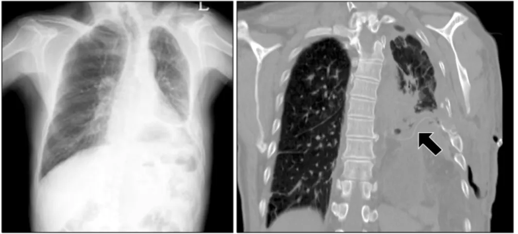 Fig. 3. Post operative chest PA  (Left) and chest CT coronal  sec-tion (Right). In chest CT finding, the  arrow showed reconstructed silicon  sheeting for diaphragm.