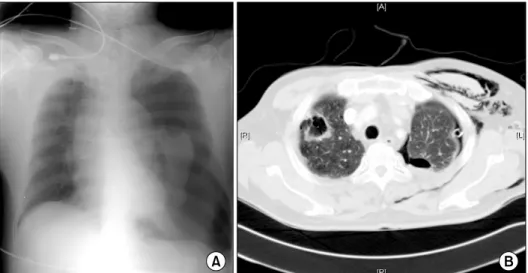 Fig. 1. Initial chest X-ray and che- che-st computerized tomography (CT). 