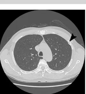 Fig. 1. Chest CT shows a left 3rd rib tumor (arrow head).