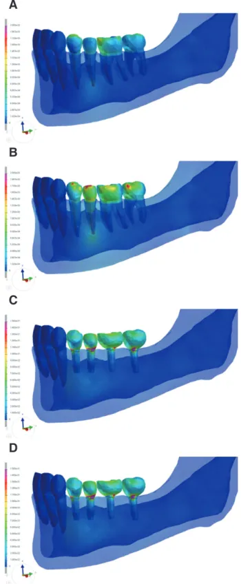 Fig. 4. Von Mises stress distribution pattern. (A) NA  model, (B) NN model, (C) IA model, (D) IN model.
