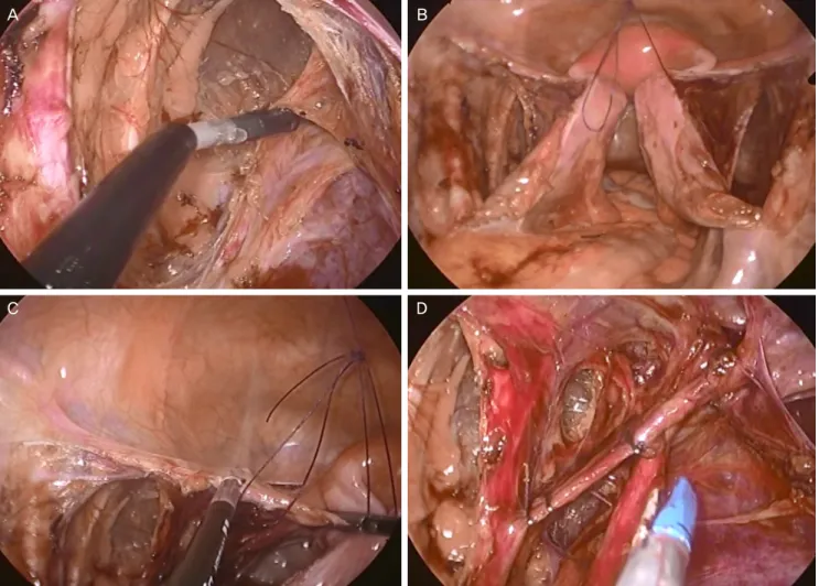 Fig. 1. (A) Identification of the uterine artery and ureter. (B) Broad ligament suture for approximation